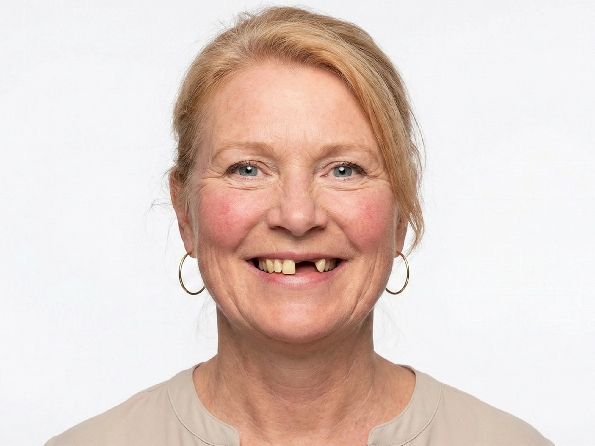 Patient smile before dental simulation