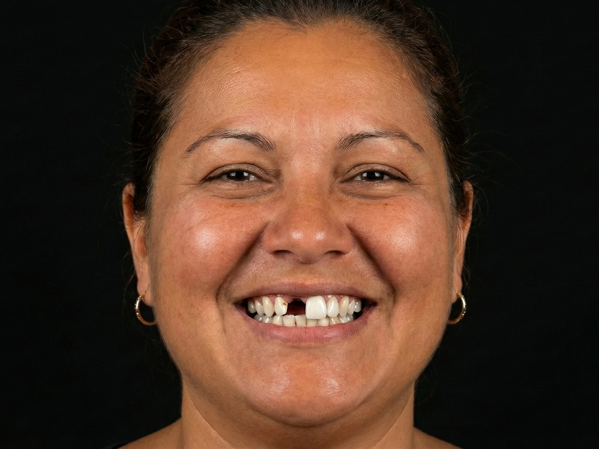 Patient smile before dental simulation