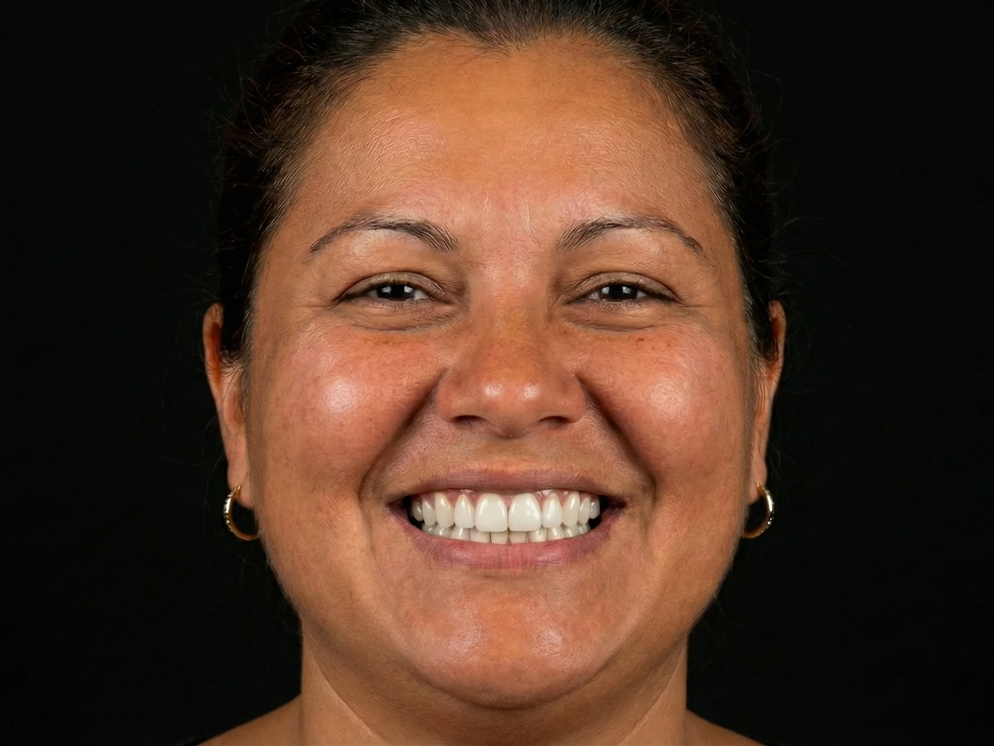 Patient smile after dental simulation preview