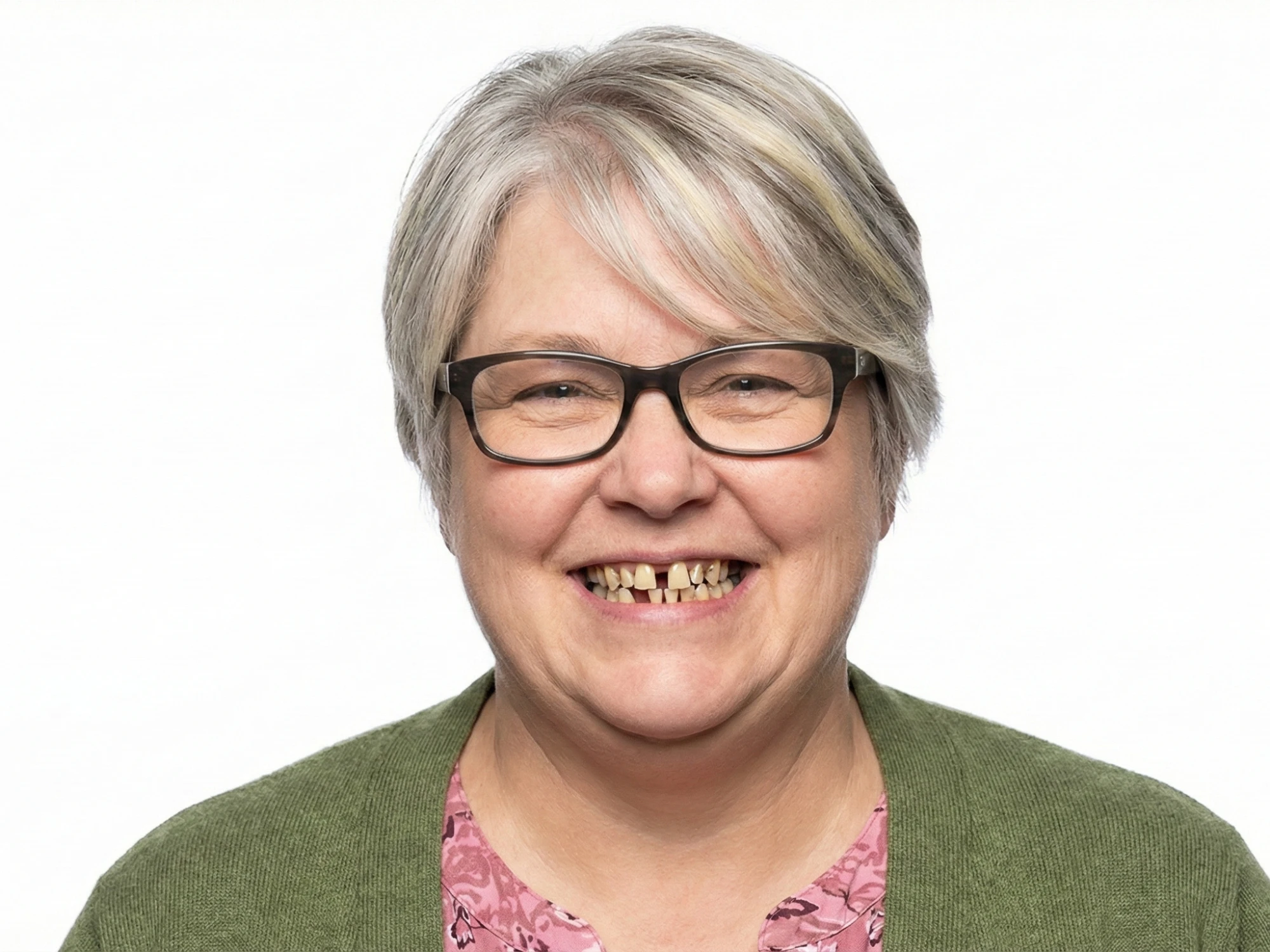Patient smile before dental simulation
